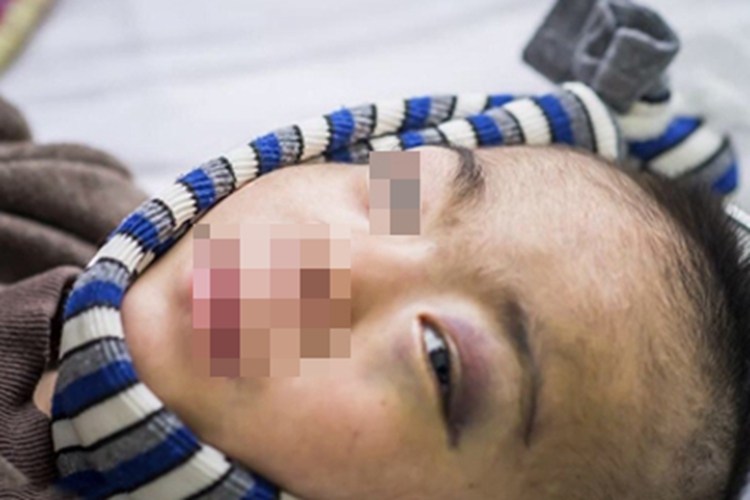 幼年型皮肌炎眼睑皮肤发紫图