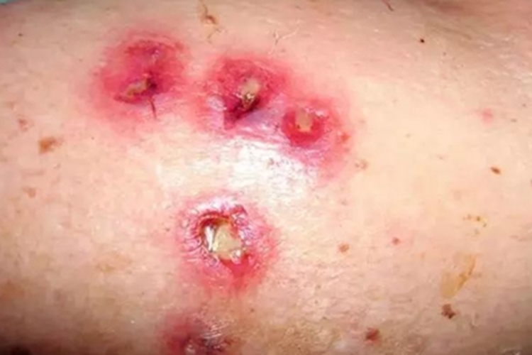 大疱型脓疱疮大腿糜烂图