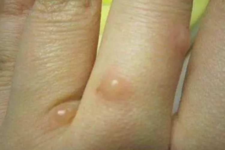 丘疹性荨麻疹手指水疱图 丘疹性荨麻疹手指水疱图