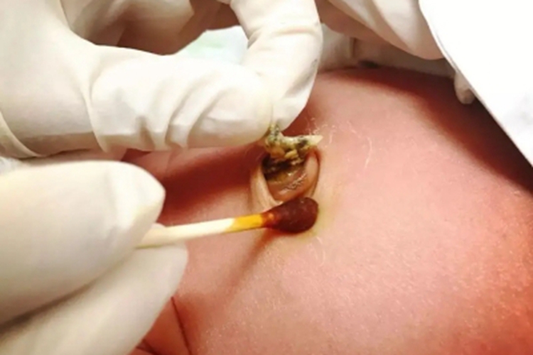 脐炎肚脐红肿发硬图 脐炎肚脐红肿发硬图