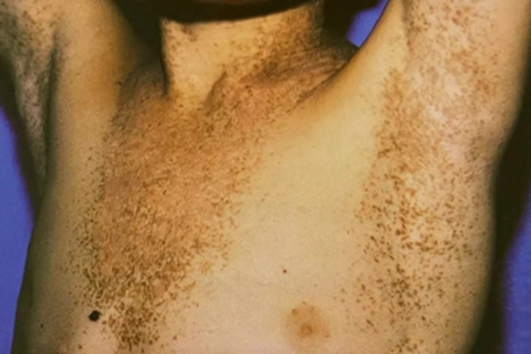 毛囊角化病胸部斑图