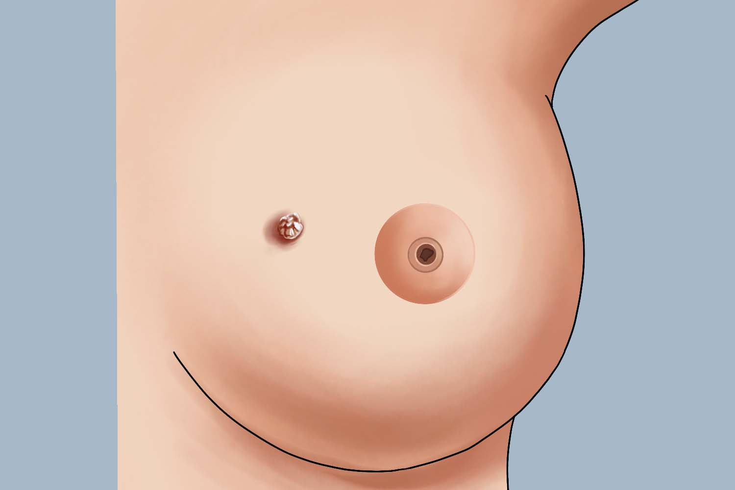 感染HPV乳房上长寻常疣图