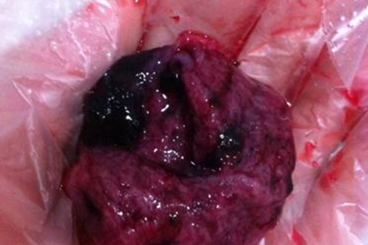 子宫蜕膜组织图