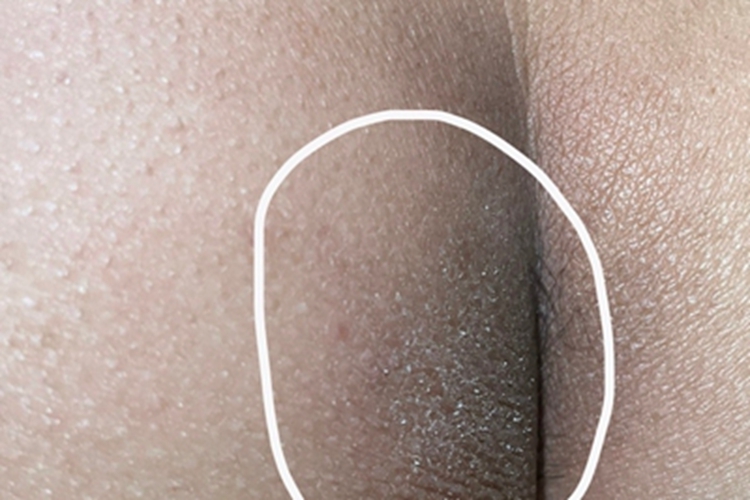 体癣臀部脱皮发黑图