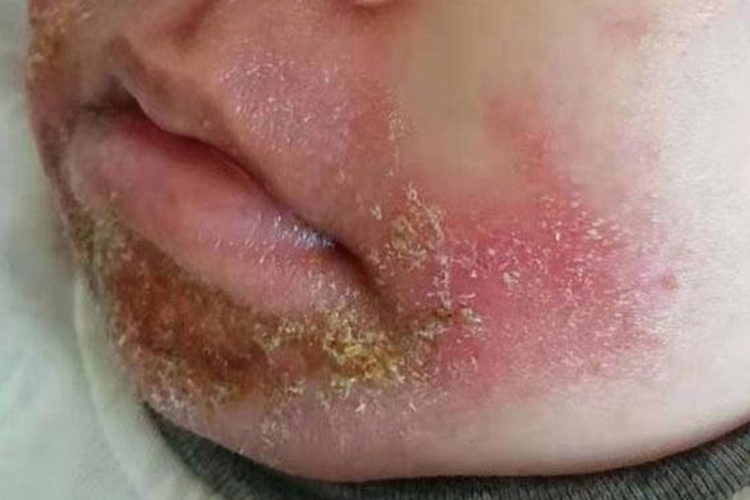 婴儿下巴脂溢性湿疹图 婴儿下巴脂溢性湿疹图