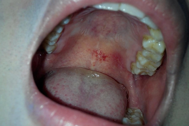 急性咽炎上腭红点图