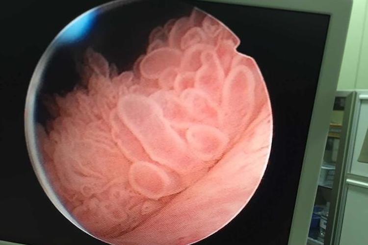 膀胱肿瘤镜下珊瑚状图 膀胱肿瘤镜下珊瑚状图