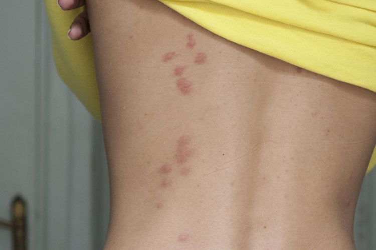 床虱咬伤后红斑图