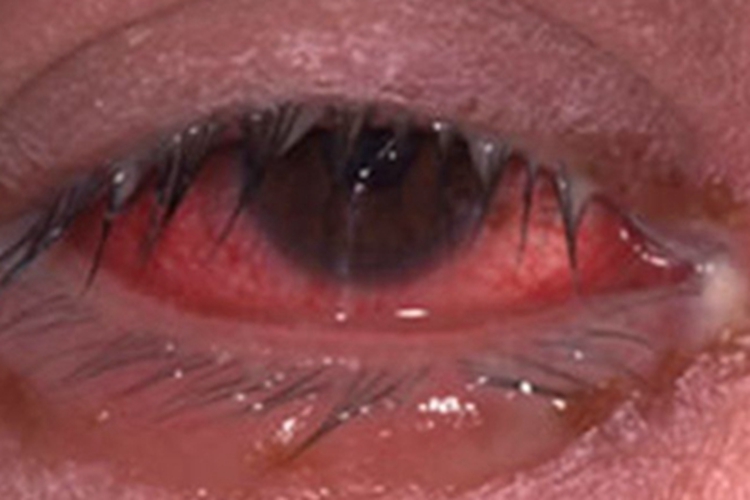 结膜炎球结膜完全充血图