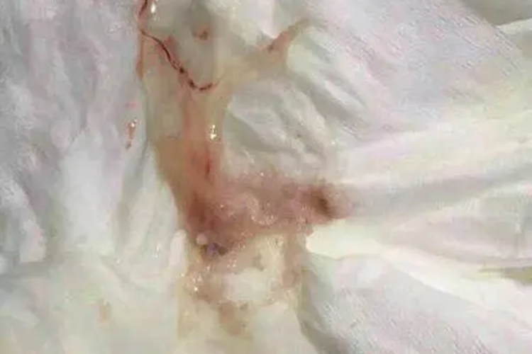 子宫内膜癌浆液性分泌物图