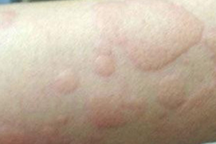 冷接触性荨麻疹胳膊风团图 冷接触性荨麻疹胳膊风团图