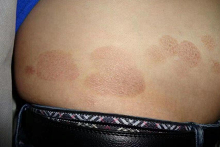 炎症后色素沉着腰部斑图 炎症后色素沉着腰部斑图