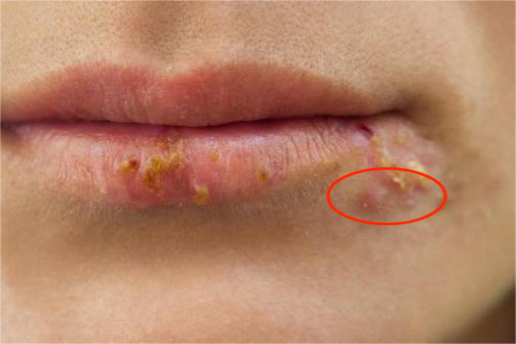 单纯疱疹嘴唇丘疹图