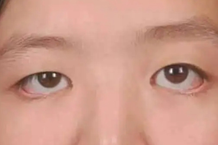 睑外翻症状图