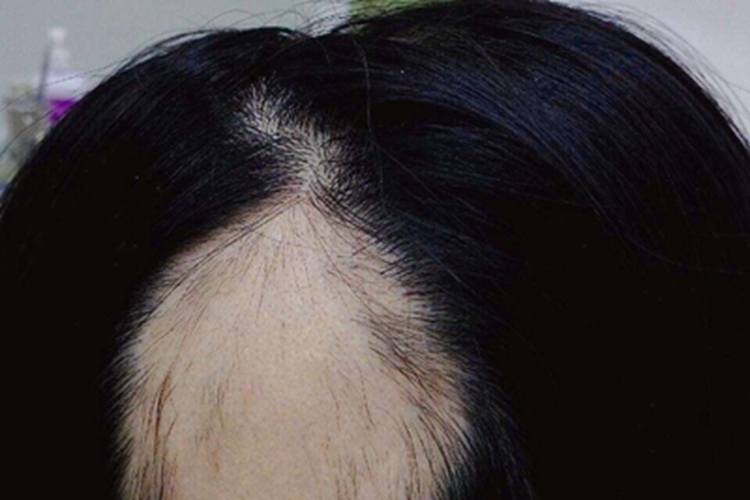 假性斑秃头顶秃了一块图