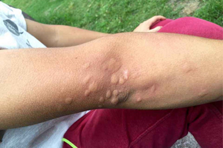 蠓虫叮咬引起的皮肤反应丘疹图