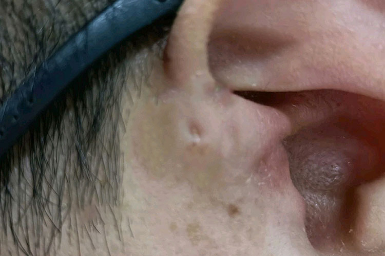 瘘管开口图 瘘管开口图