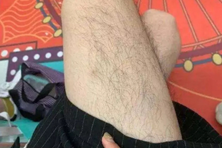多毛症大腿症状图 多毛症大腿症状图