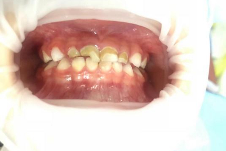 奶瓶龋齿环状龋图