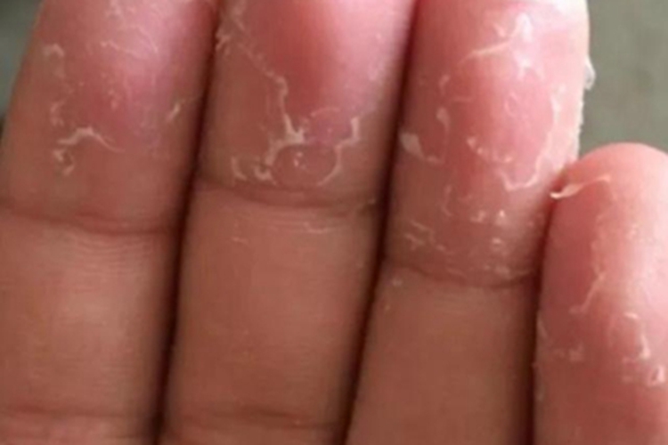 川崎病手指脱皮图