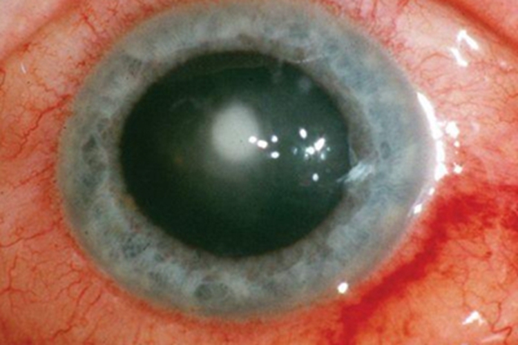 细菌性角膜溃疡眼睛有斑块图