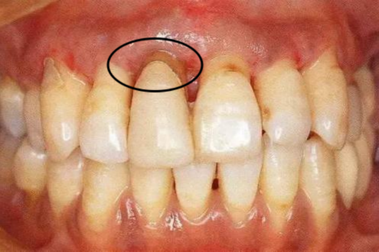 可复性牙髓炎图