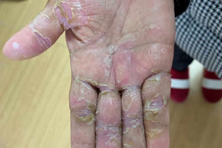 4级手足综合征手部有大片脱皮图 4级手足综合征手部有大片脱皮图