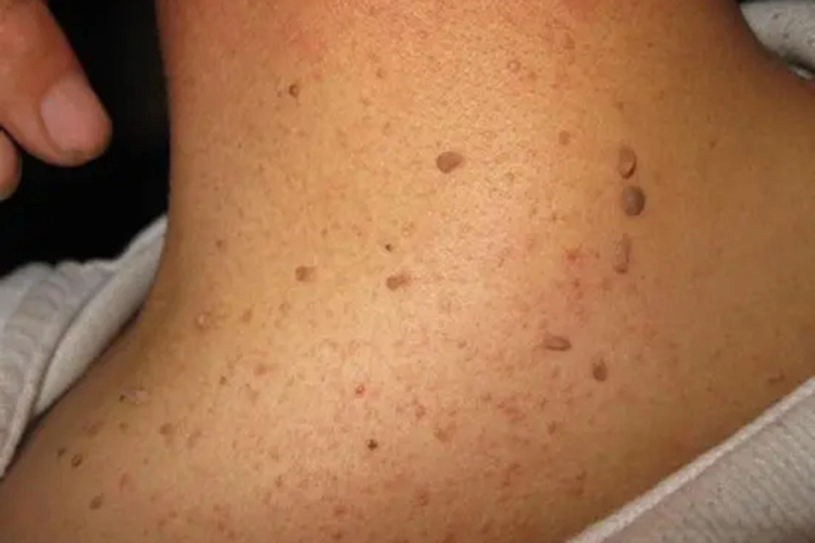 颈部软纤维瘤图 颈部软纤维瘤图