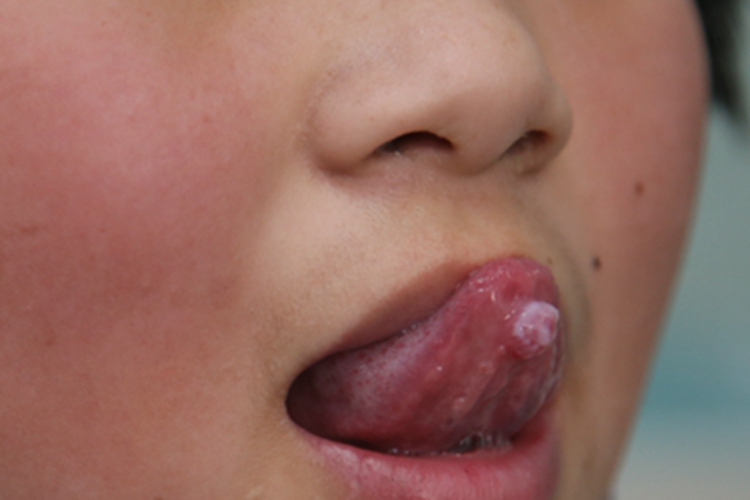 黏液腺囊肿舌尖圆疙瘩图 黏液腺囊肿舌尖圆疙瘩图