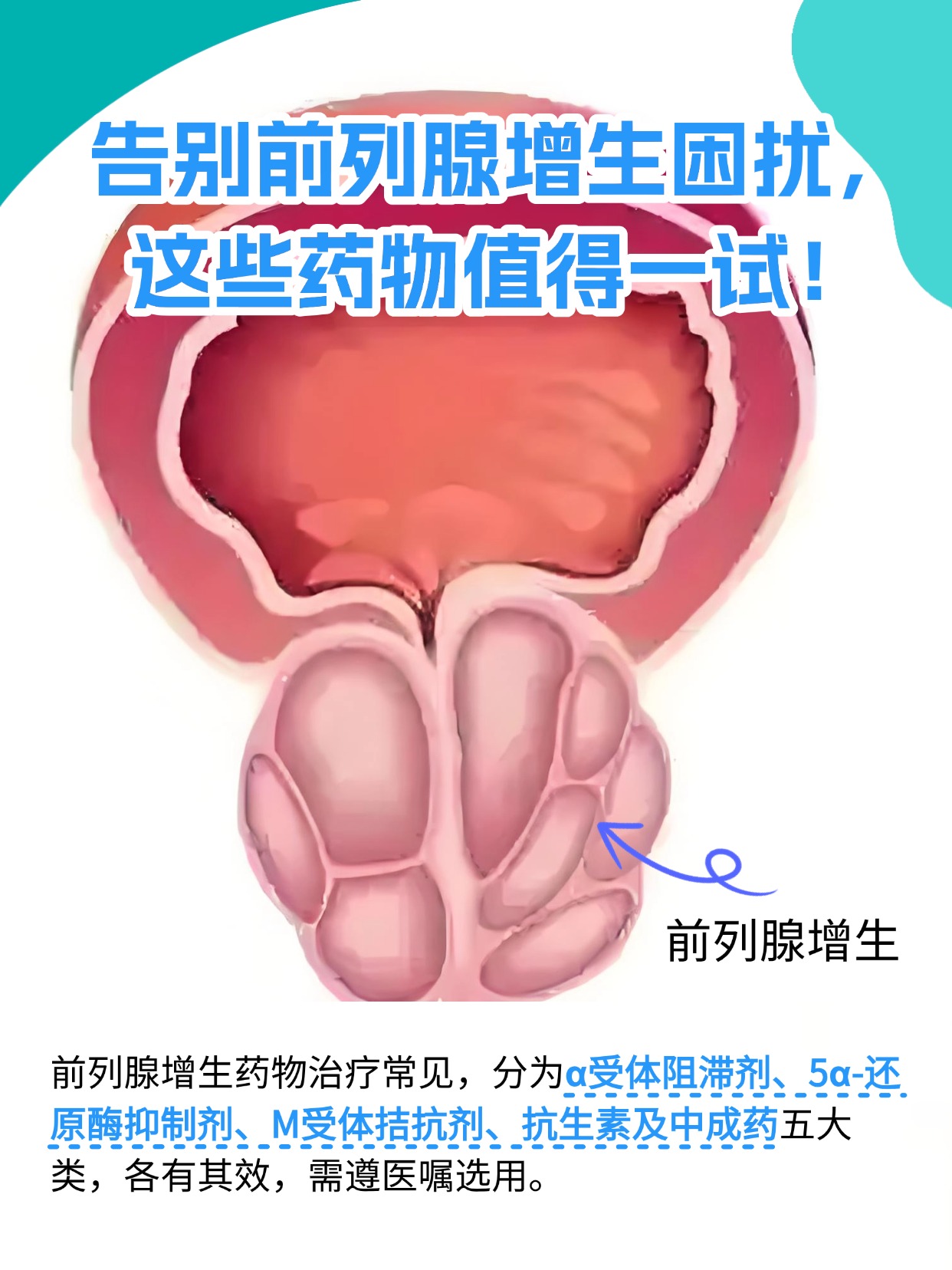 告别前列腺增生困扰，这些药物值得一试！