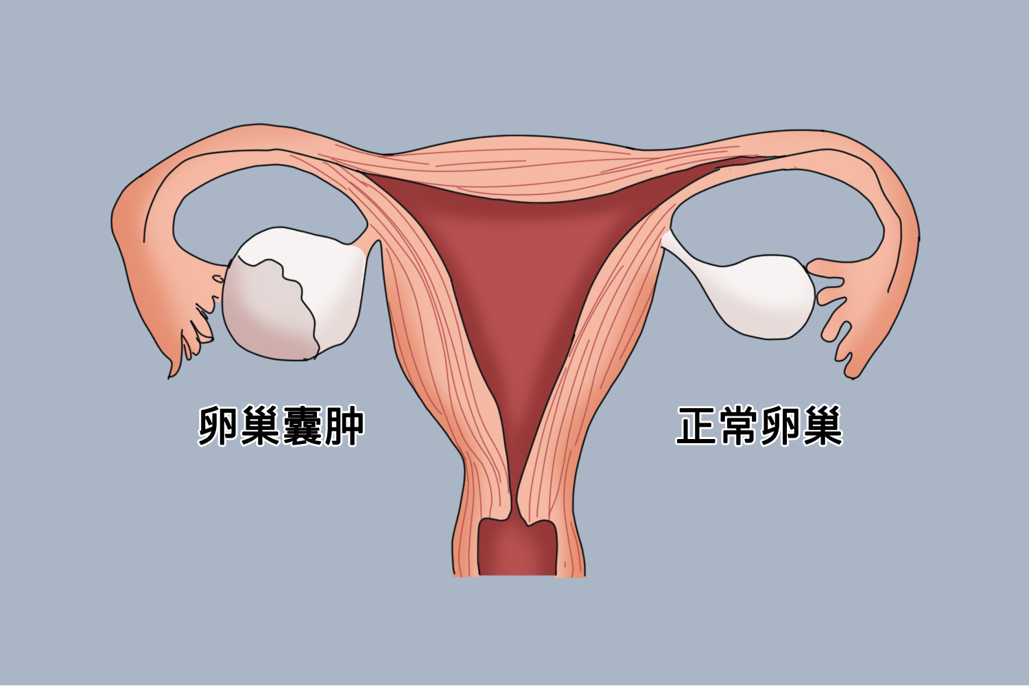 卵巢囊肿与正常卵巢图