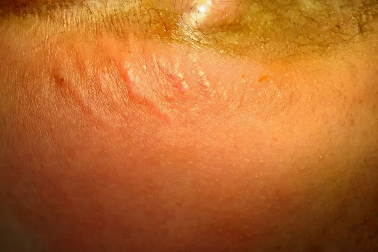 肛瘘早期局部脓肿图