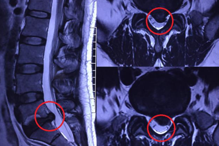 腰间盘突出ct片教程图片