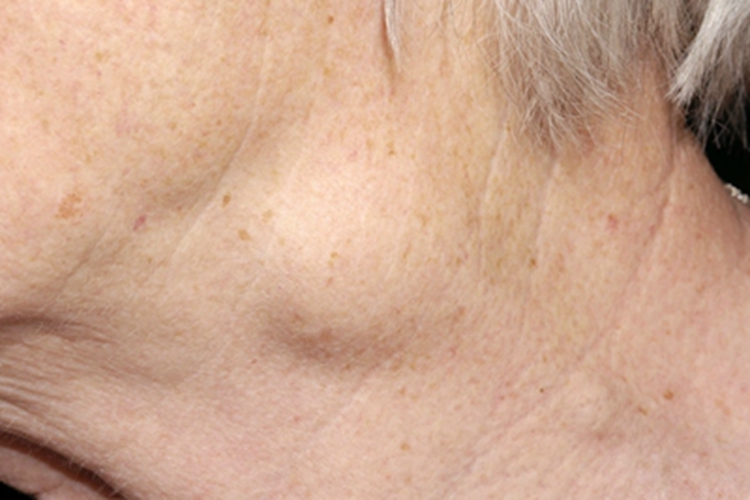 海绵状淋巴管瘤侧颈包块图