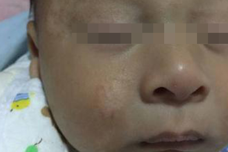 宝宝湿疹后色素沉着图