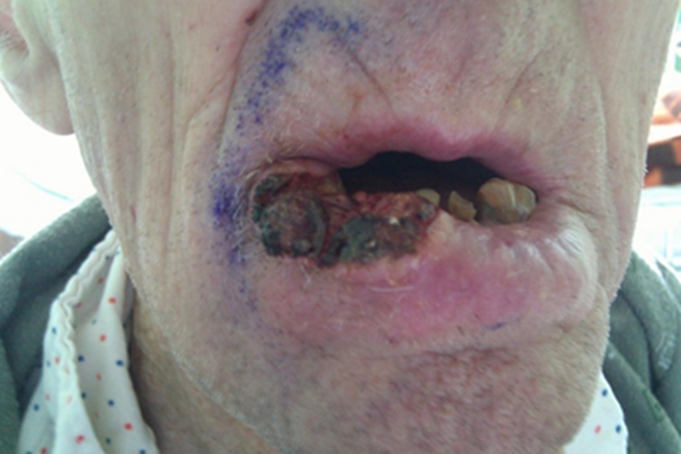 唇癌下嘴唇烂嘴角结厚痂图 唇癌下嘴唇烂嘴角结厚痂图