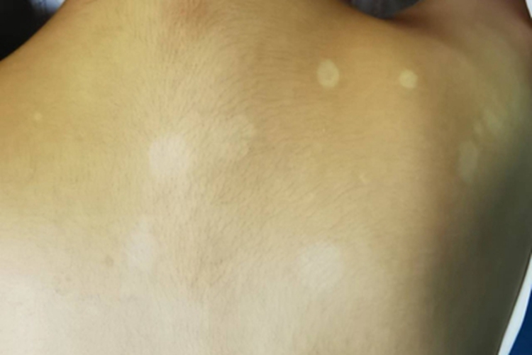 花斑糠疹后背有白色斑块图