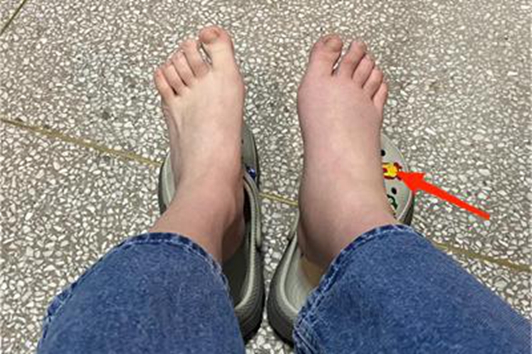 踝扭伤脚踝内侧肿胀图