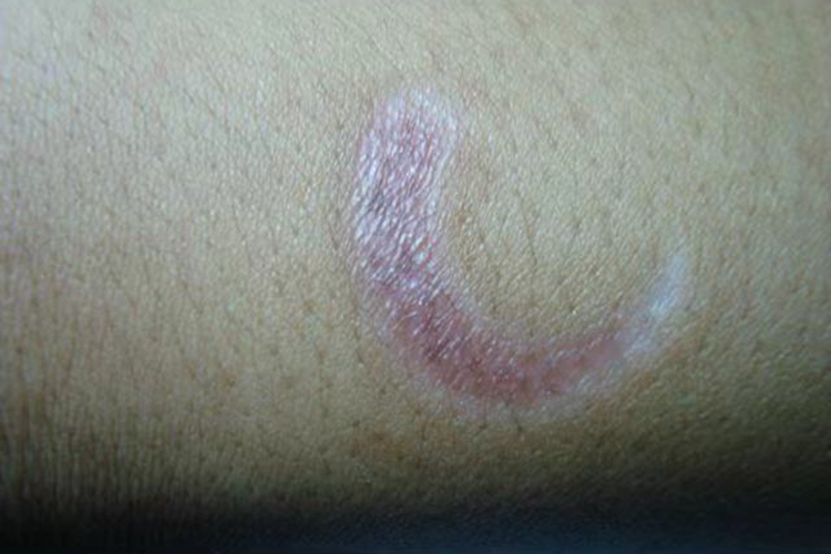 伤口愈合淡粉红色图 伤口愈合淡粉红色图