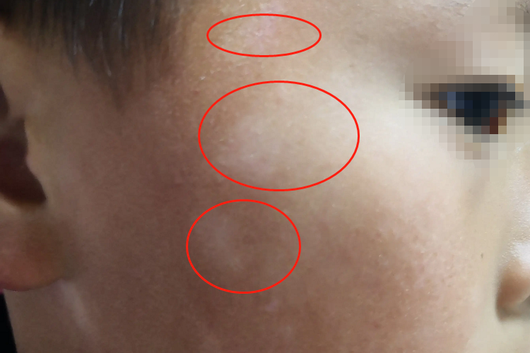 宝宝脸上有虫斑图