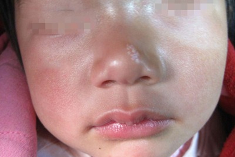 原发性粟丘疹鼻尖丘疹图