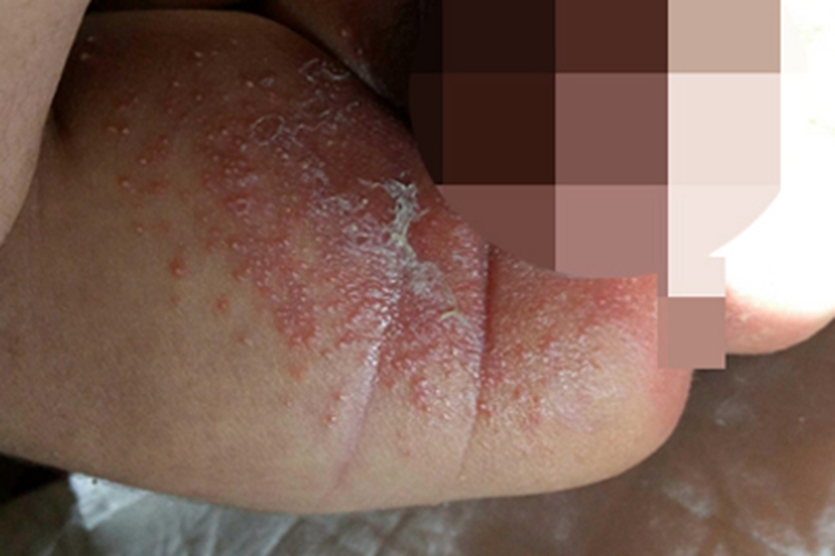 尿布皮炎大腿根有两块红斑图