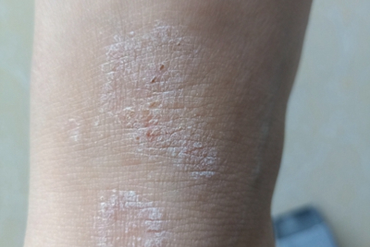 体癣小腿苔藓样变图