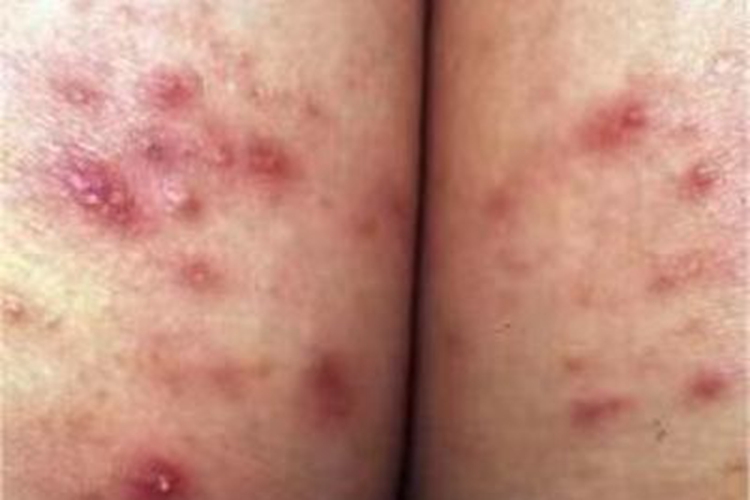 细菌性毛囊炎臀部症状图 细菌性毛囊炎臀部症状图