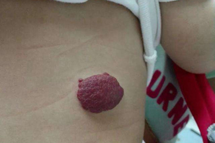 血管角化瘤腹部长瘤图