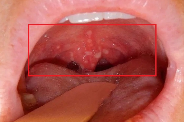 小儿疱疹性咽峡炎口腔白斑图 小儿疱疹性咽峡炎口腔白斑图