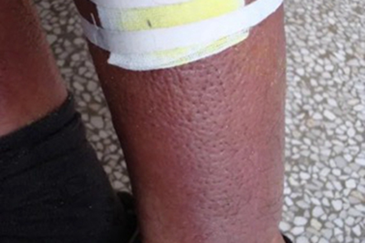 黏液水肿性苔藓小腿皮肤增厚图