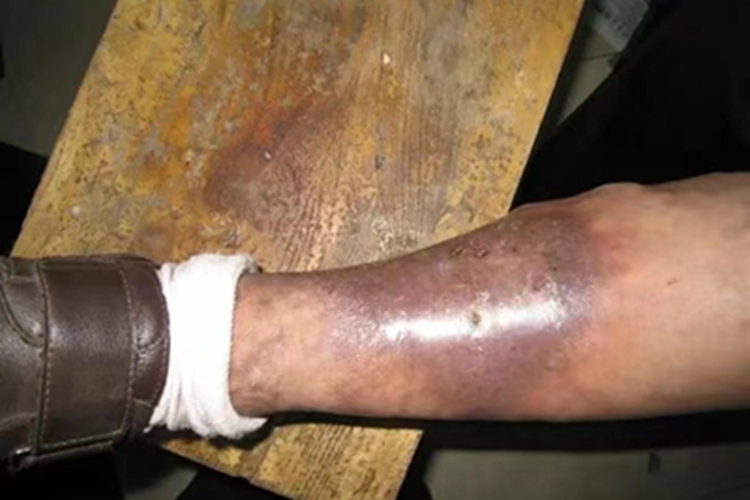 四肢血栓性浅静脉炎小腿有紫斑图 四肢血栓性浅静脉炎小腿有紫斑图