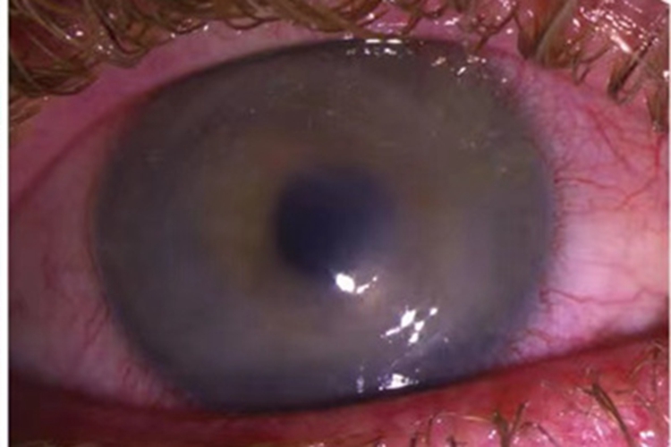 棘阿米巴角膜炎眼球混浊图