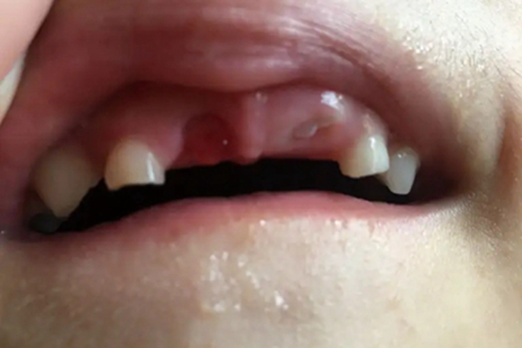 牙龈纤维瘤病红肿图 牙龈纤维瘤病红肿图